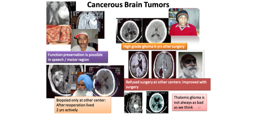 cancerous brain